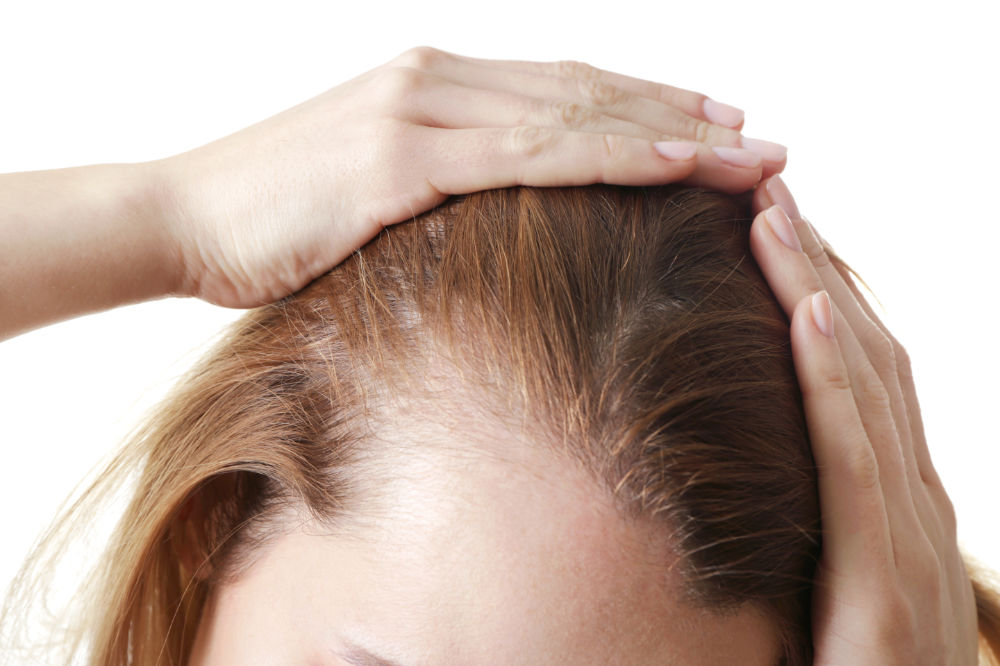 What Is Female Pattern Baldness and Can It Be Treated? - Hair & Skin ...