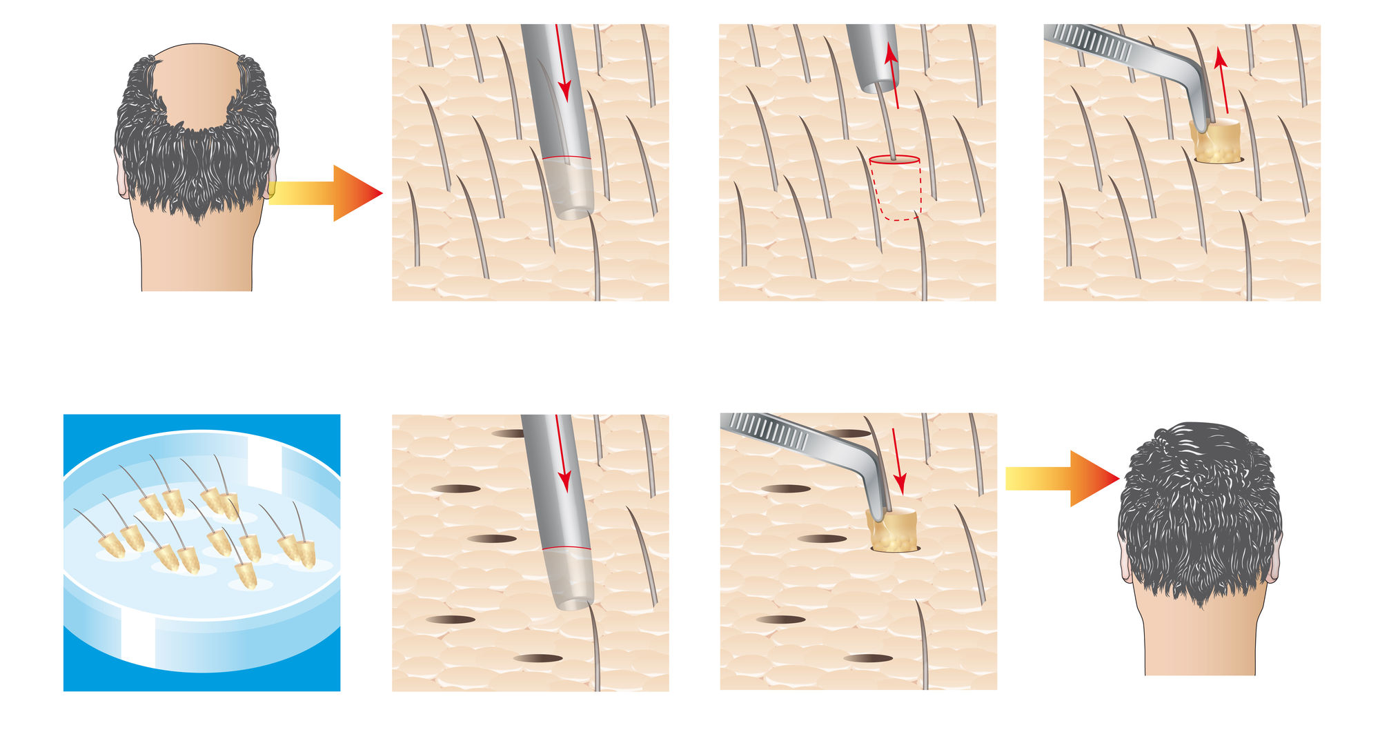 The Ultimate Guide To Hair Transplants 1